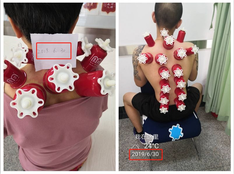 用孟氏拔罐冬病夏治你治病我送拔罐擦剂