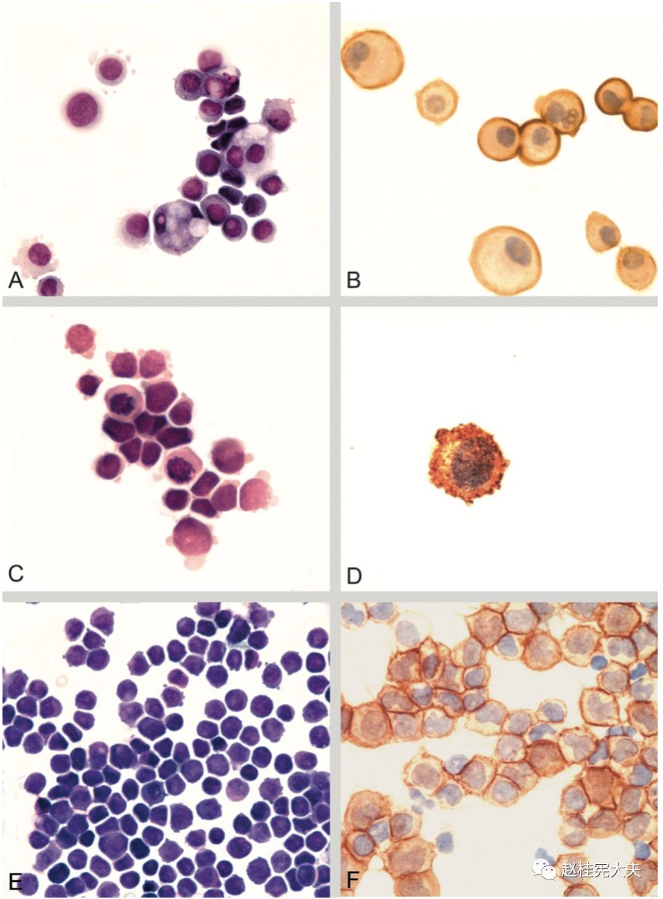 关于脑脊液细胞学有了这篇你就统统了解了