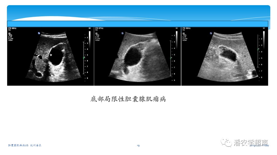 胆囊息肉彩超图片图片