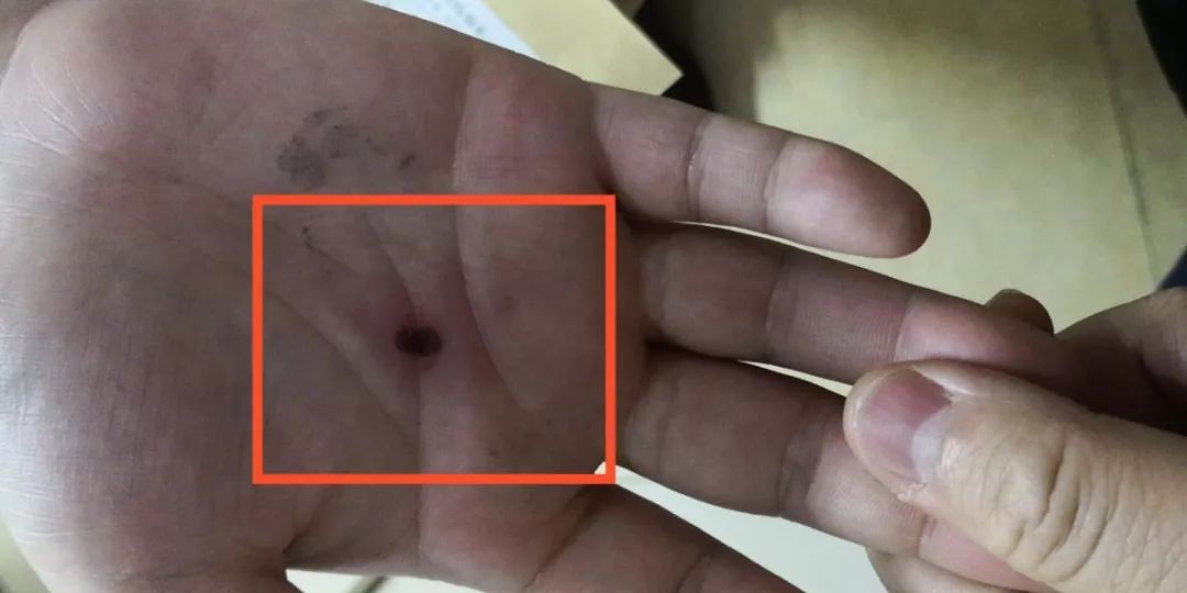 视频,用筷子开啤酒瓶盖,没想到表演没有成功,反而将筷子折断在手掌中