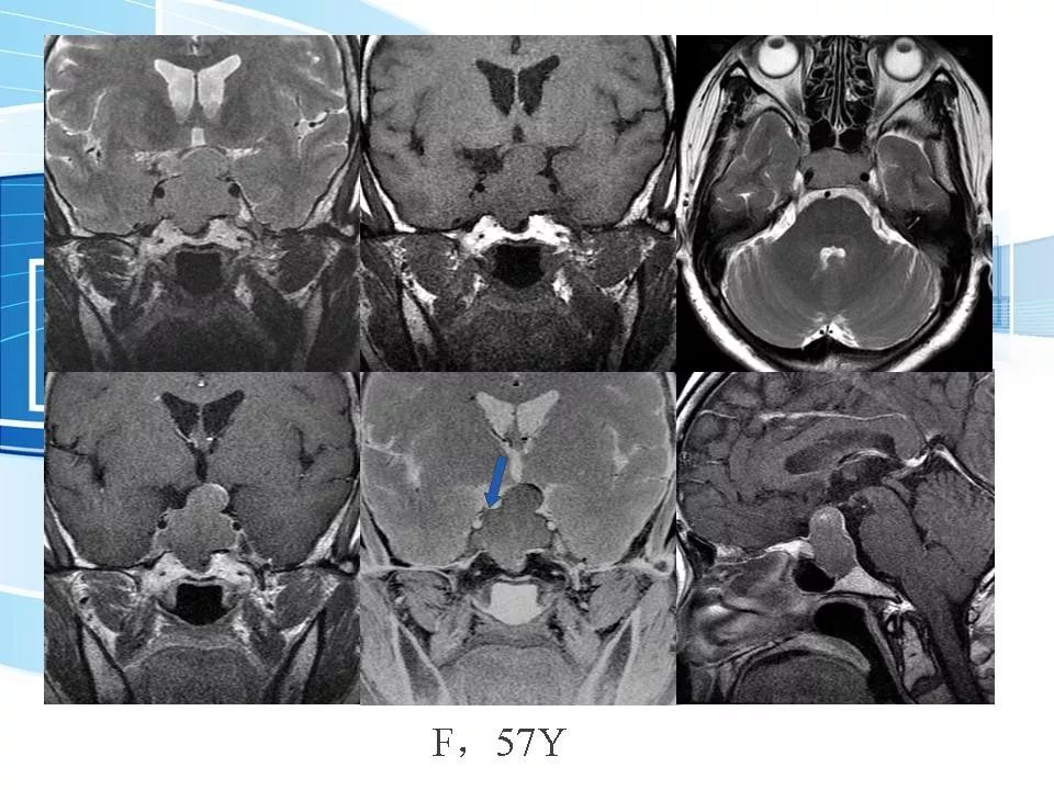 侵袭性垂体瘤mr征象分析影像天地