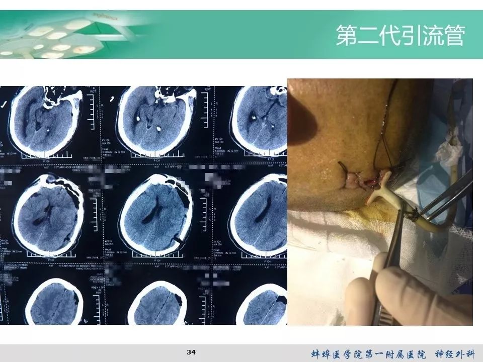 自制單管雙腔引流管治療慢性硬膜下血腫顱腦創傷神經重症病例週刊124