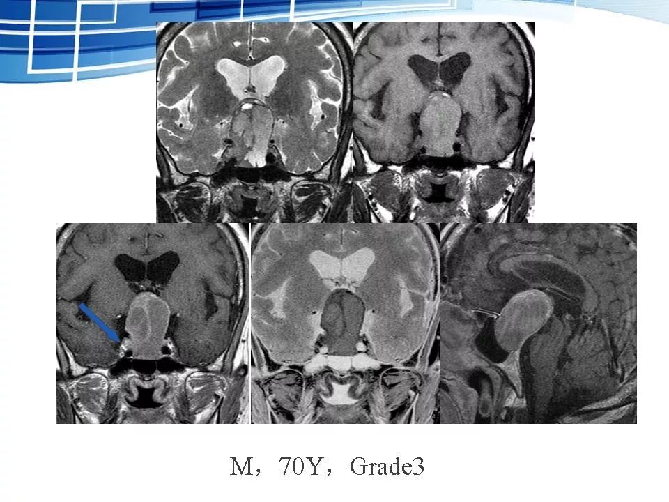 侵袭性垂体瘤mr征象分析影像天地