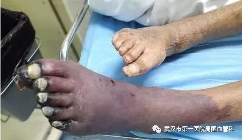 三分钟读懂下肢动脉硬化闭塞症