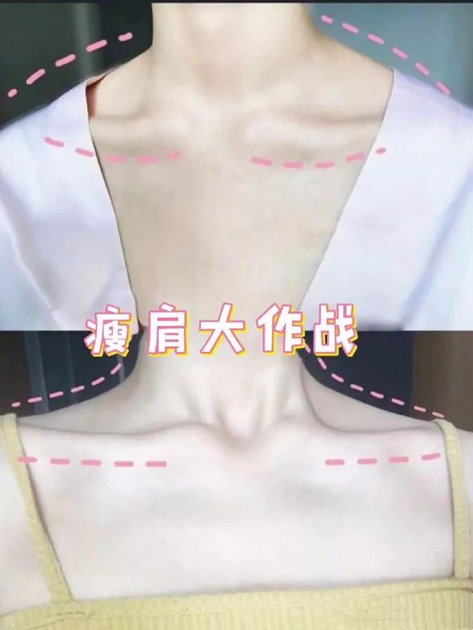 肉毒素注射瘦肩原价6000元夏日狂欢三部曲小v脸 天鹅颈 美人肩惊喜