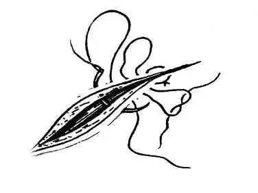 学习图文并茂详解各种外科缝合方法