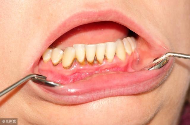 牙龈炎牙石等经常堆积在牙体周围,会让细菌大量繁殖,侵蚀牙龈