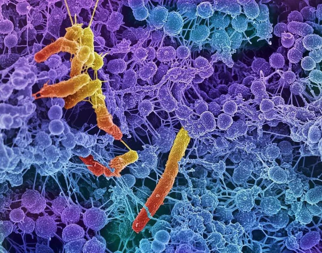 高伟丽详解| 牙周病不要以为刷牙就能预防!_细菌