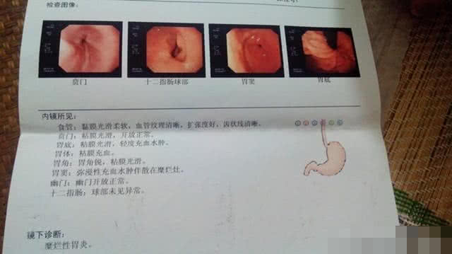 急性糜烂性胃炎是以胃黏膜多发性糜烂为特征的急性胃炎,又称急性胃