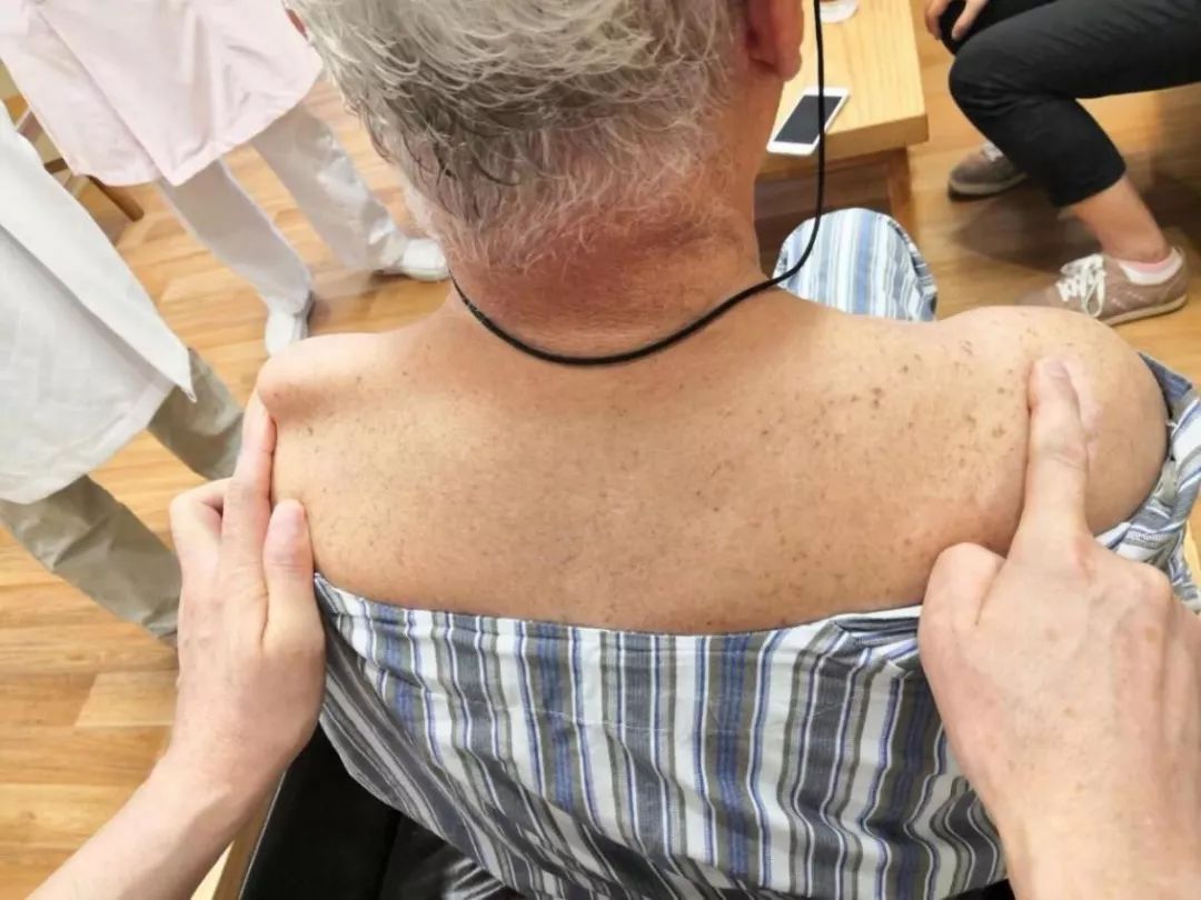 术前外观照肩锁关节畸形x线示肩锁关节脱位手术中tightrope微孔钢板