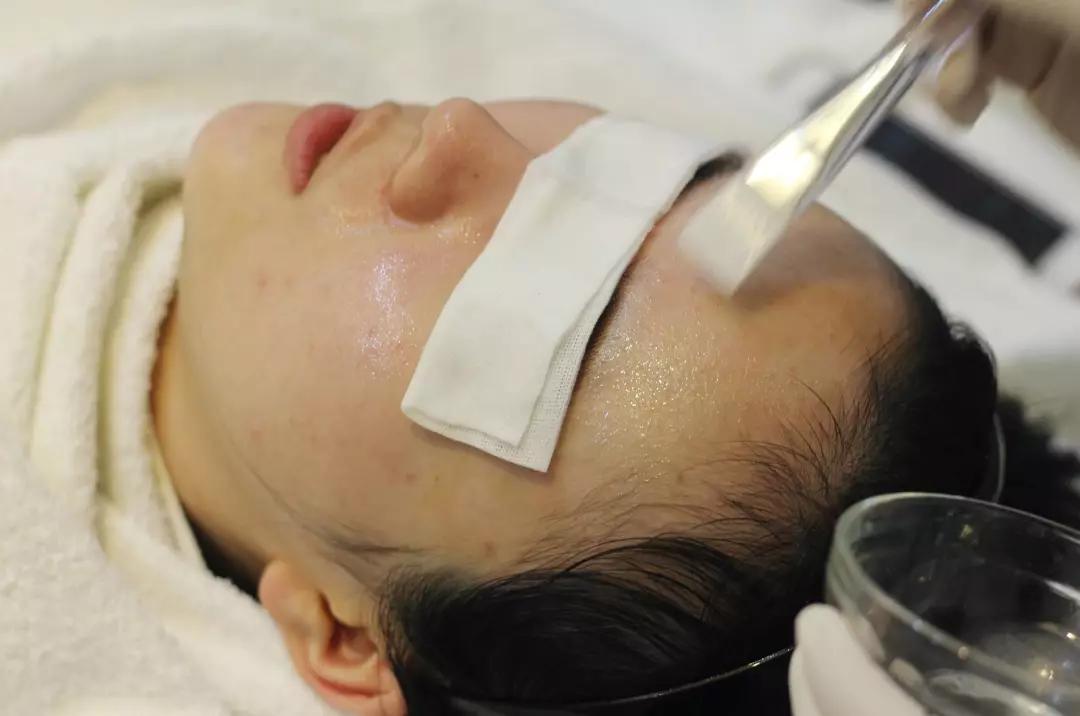 毛孔粗大,你可以考虑一下果酸换肤_皮肤