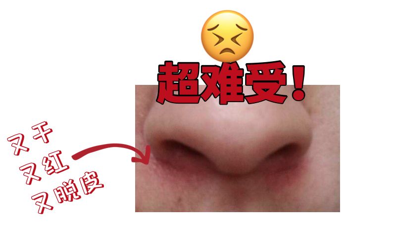 擤鼻涕把鼻子都擤红了咋办
