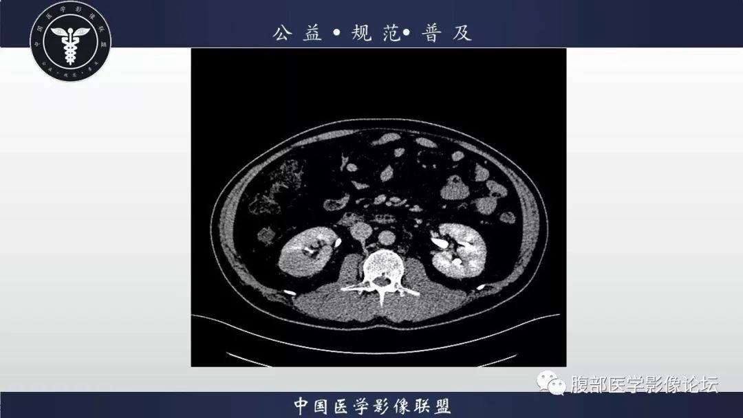 右肾透明细胞癌