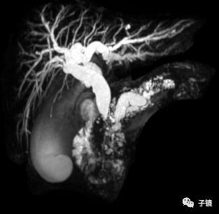 王東教授慢性胰腺炎並胰管結石膽總狹窄ercp處理策略學習筆記