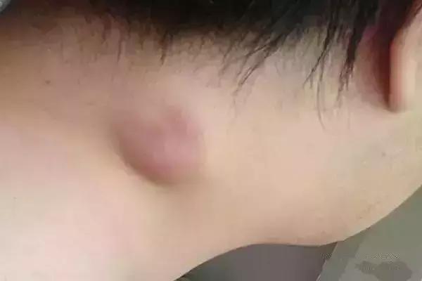 这些小疙瘩暗示肿瘤来临速看