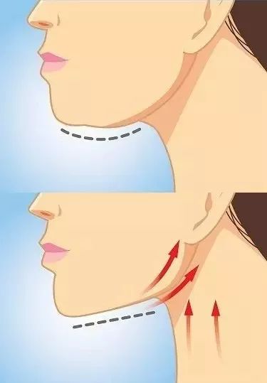 使用肉毒素对下颌缘v线进行注射,针对颈阔肌,颏肌,颊肌,嘴角肌等四大