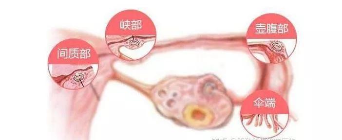 输卵管堵塞会导致不孕造成输卵管堵塞的原因
