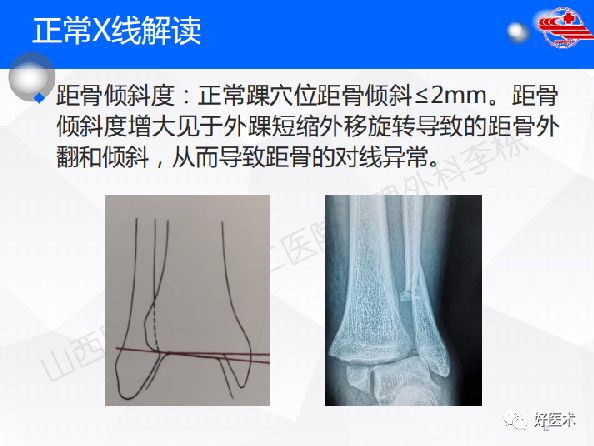 踝关节x线解剖 解剖图图片
