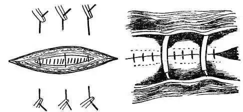 图文并茂详解各种外科缝合方法