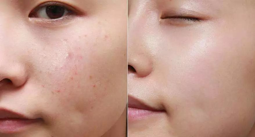 痘痘肌正确的护理方法是什么?千万别动不动就用手挤!