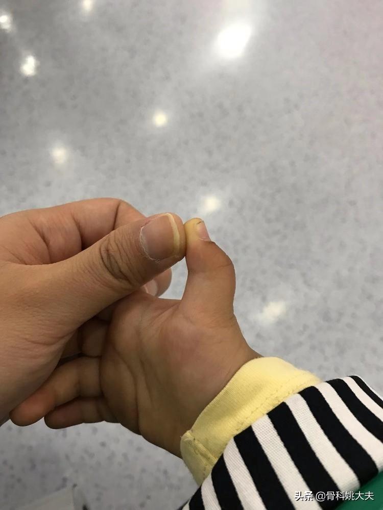 这种情况是拇指狭窄性腱鞘炎,又称扳机指,掰直时伴有响声,所以又叫"弹