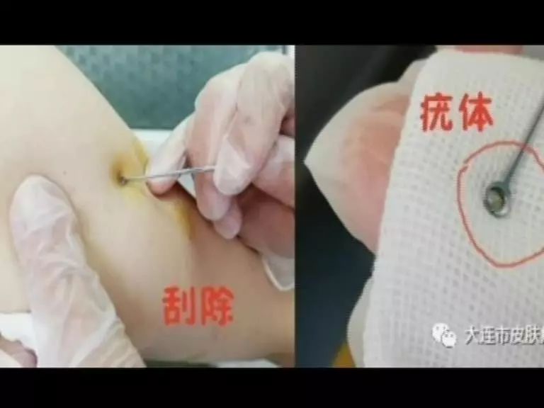 孩子得了这种病吃药没啥用医院是这么弄的