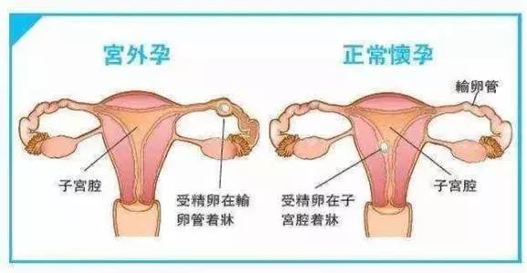 宮外孕又稱異位妊娠,指孕卵在子宮腔外著床發育的異常妊娠過程,以