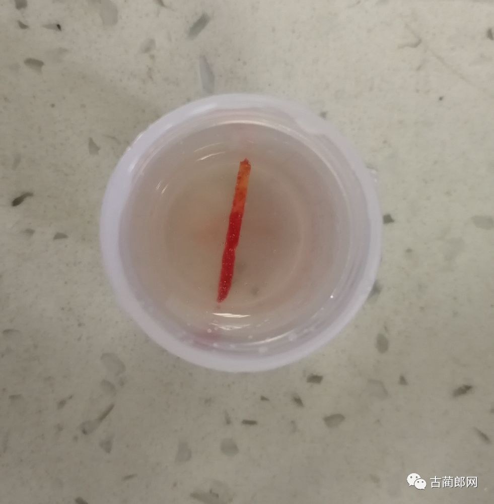 厉害古蔺人医成功开展一例骨髓活检术