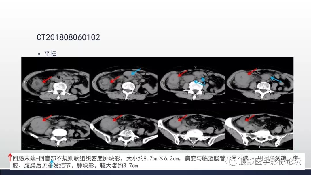 回盲瓣在ct影像的图片图片