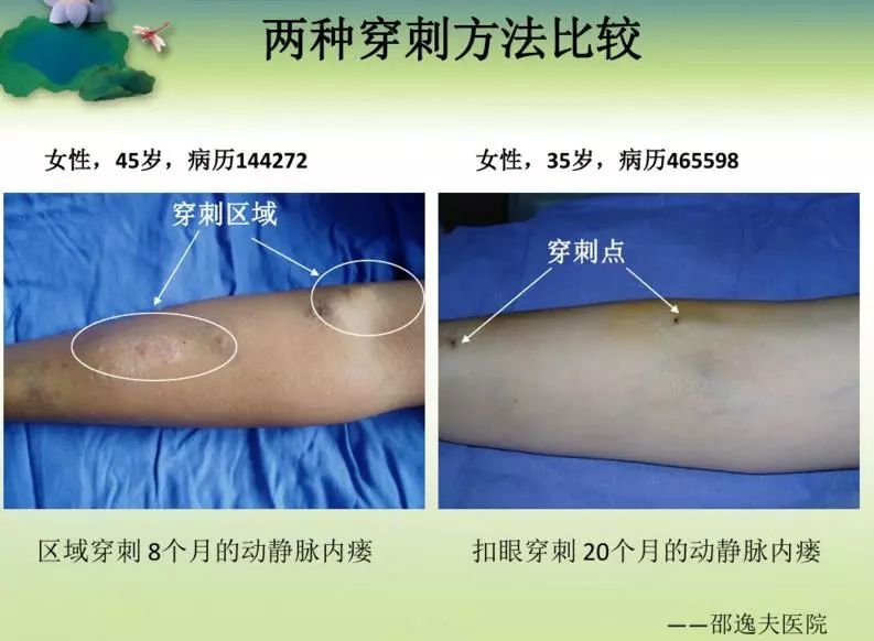 护士你会钝针穿刺吗