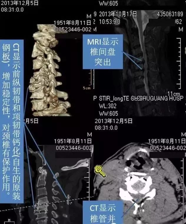颈椎病诊治十大误区——不知害了多少人