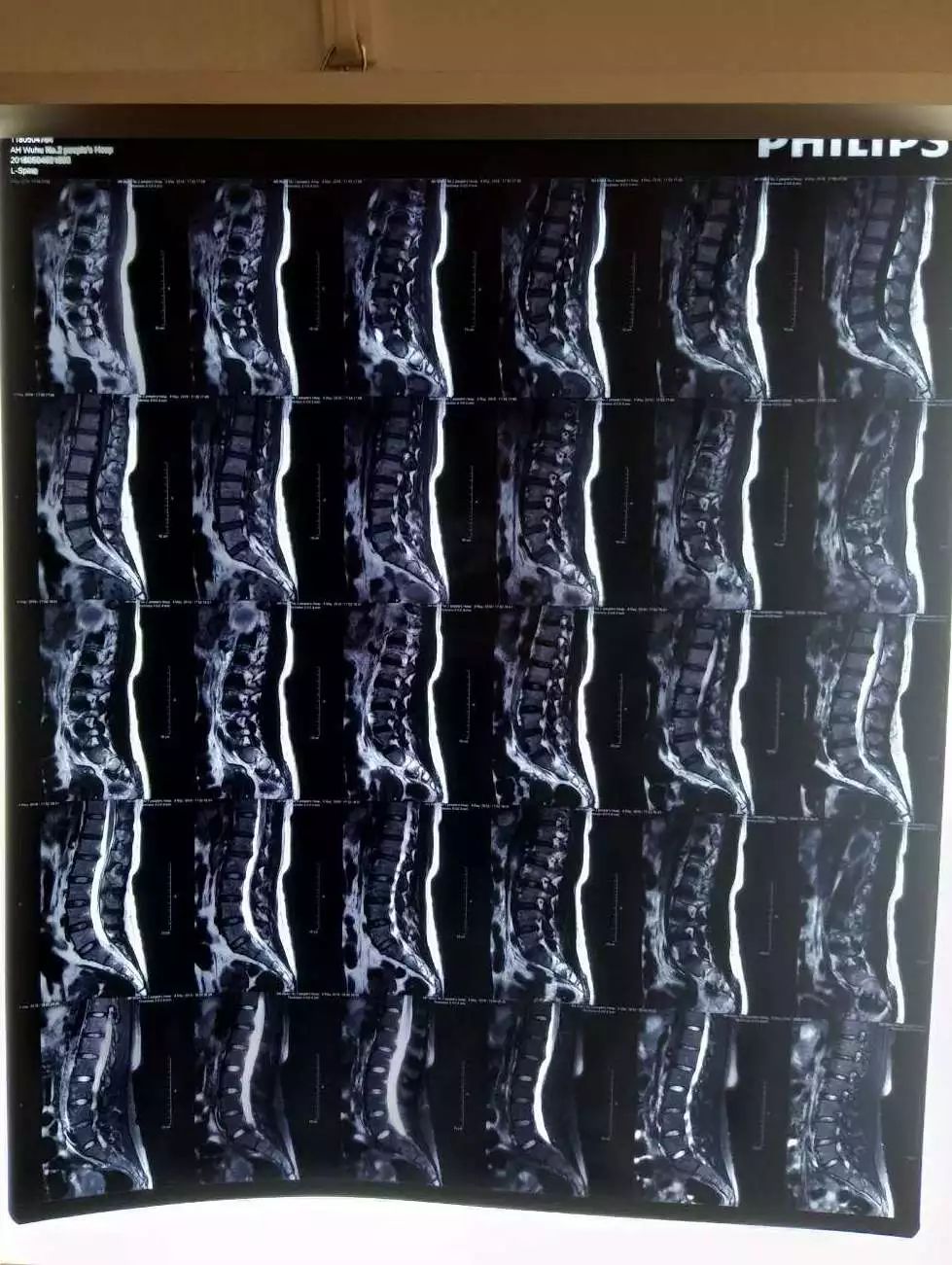 腰肌劳损核磁共振图片图片