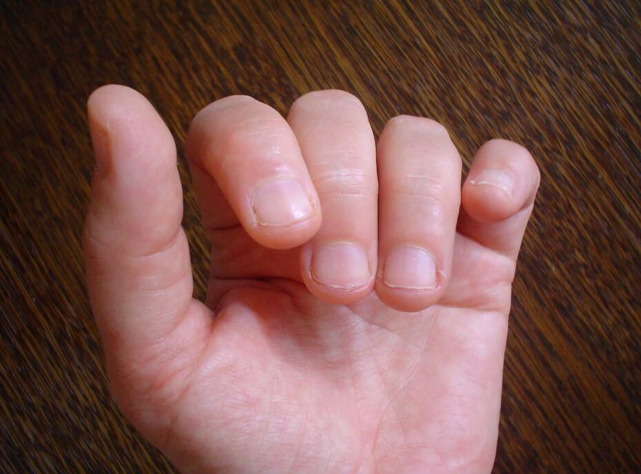 肾虚藏着掖着也没用,小手一伸,指甲3种变化已暴露你