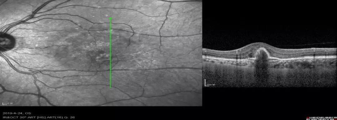 黄斑不是病,黄斑病了才是病