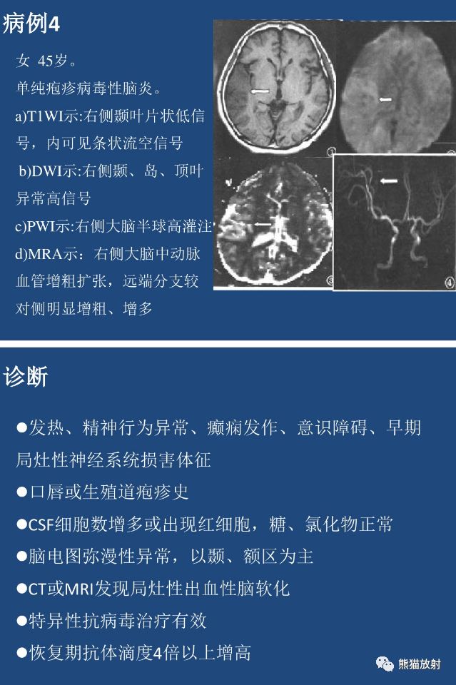 一图秒懂丨单纯疱疹病毒性脑炎(hse)