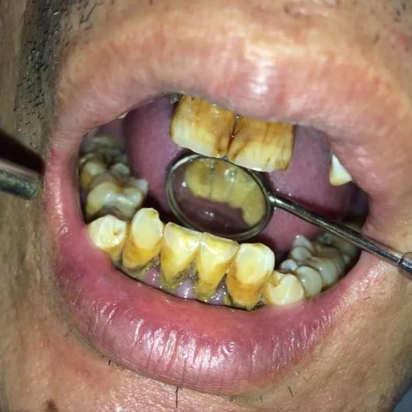 最强的牙结石患者抠下一块你能闻多久