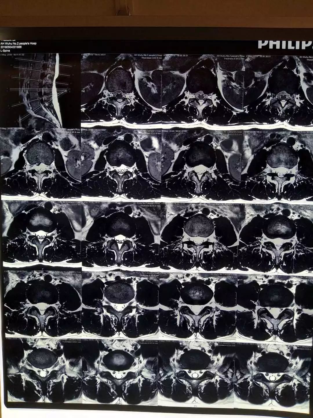 效果不佳,然后又到南京军区医院再次做mri,诊断结果为腰部拉伤,腰肌