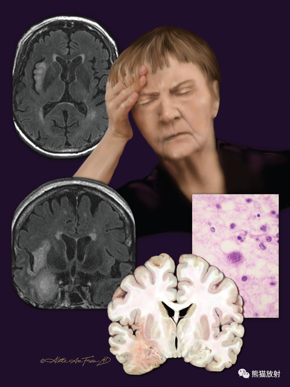 axial (top left) and coronal (bottom left) t2