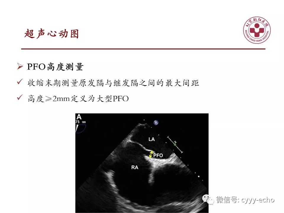 識別與隱源性腦卒中相關的高風險卵圓孔未閉評分系統的建立