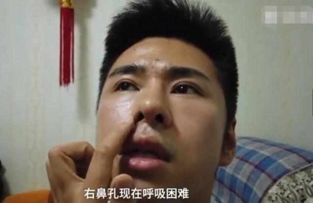 鼻子歪了 男人图片