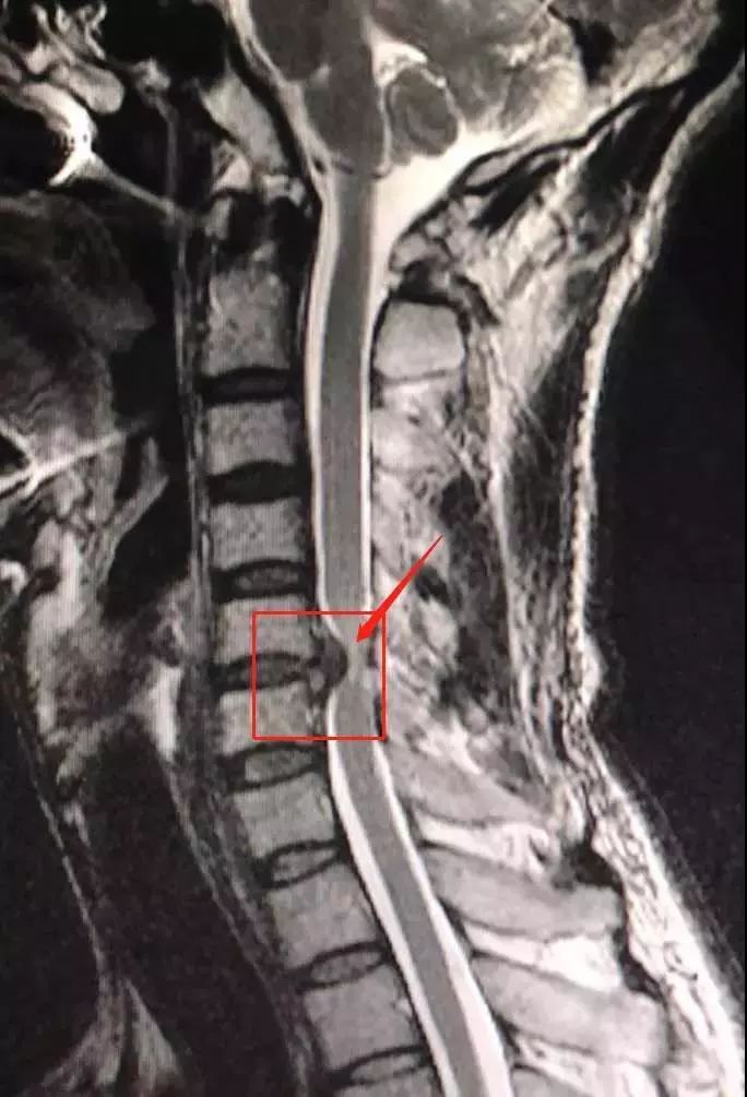 颈部核磁共振片子显示颈椎5,6节间的椎间盘向右膨出