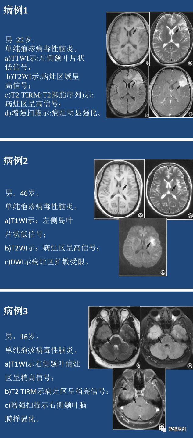 一图秒懂丨单纯疱疹病毒性脑炎(hse)