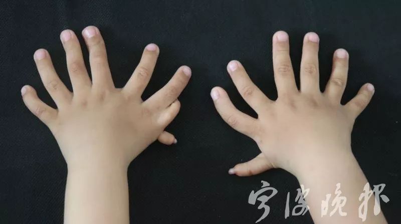 宁波医生为3岁男孩切除11个手指脚趾父母喜极而泣