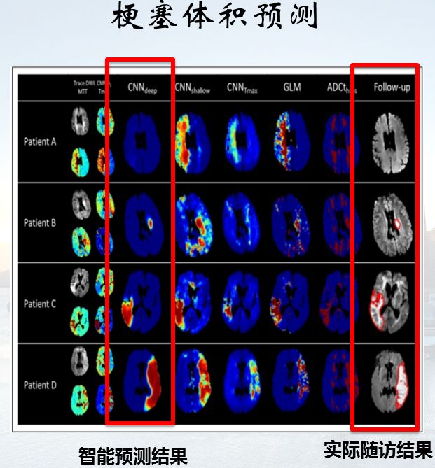 2018年neuroradiology杂志发表文章显示基于ct的自动化aspect评分系统