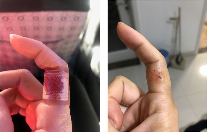 本想勤快大扫除的小编,就是被这个牌子的拖把划伤手指,缝了2针伤人的