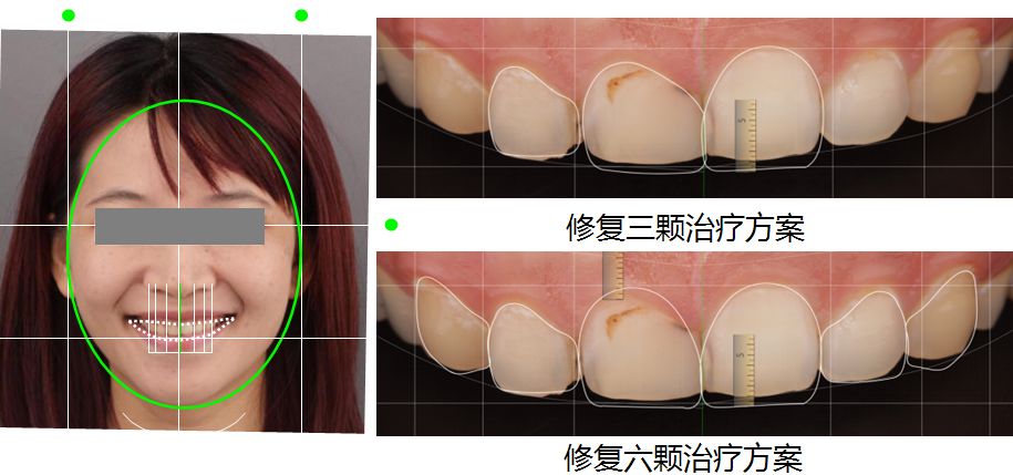 前牙龋坏伴牙体比例不协调铸瓷贴面修复一例