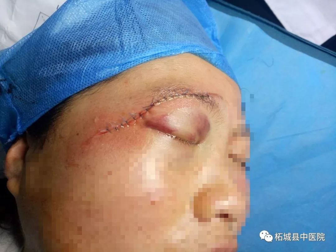 3,在确保视功能的同时行一期美容缝合,恢复眼睑正常外观,为患