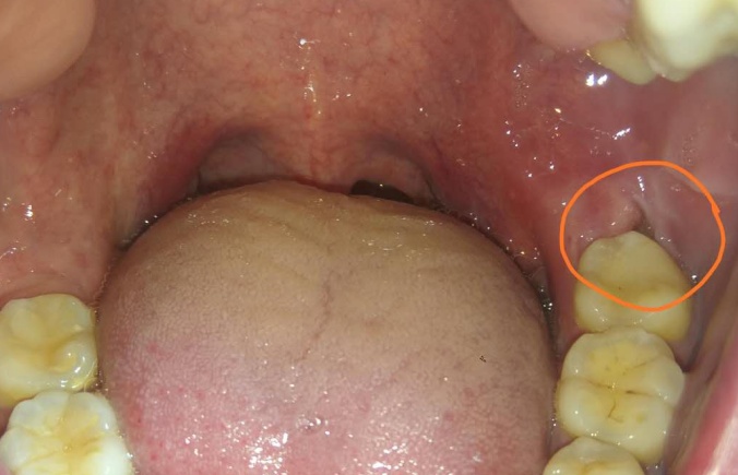 发现智齿蛀牙需要拔掉吗医生提醒别犹豫了