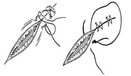 图文并茂!详解各种外科缝合方法