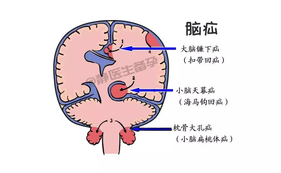 脑疝的部位图片图片